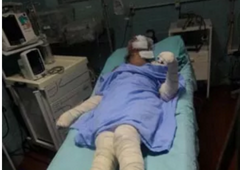 Jovem de 18 anos tem 80% do corpo queimado pelo companheiro 