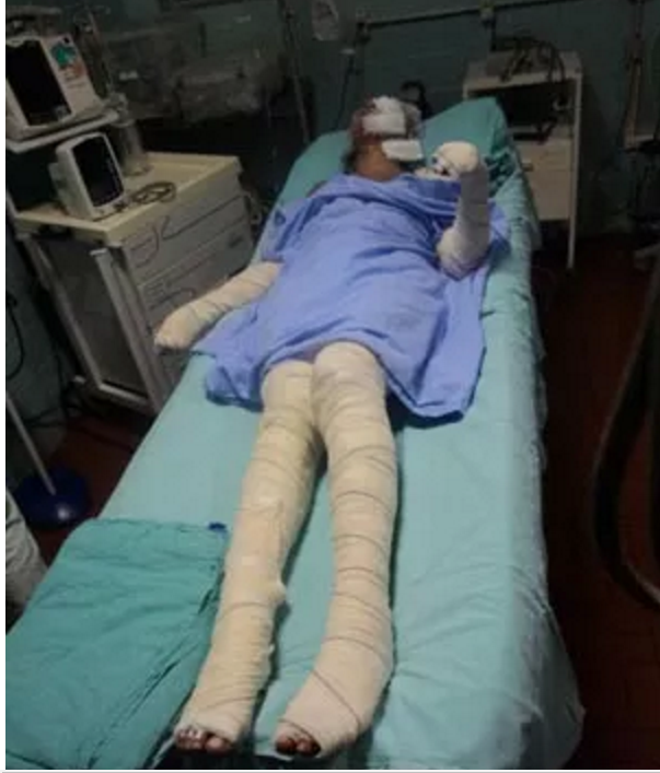 Jovem de 18 anos tem 80% do corpo queimado pelo companheiro 