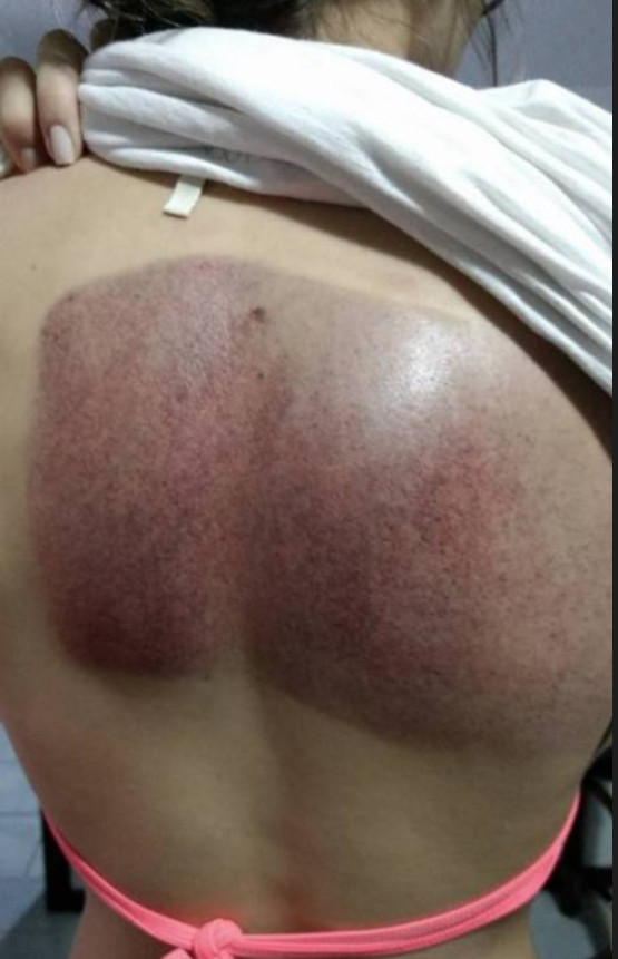 Mulher desabafa no Facebook após ser sugada na piscina 