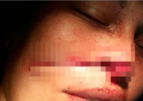 Com ciúmes, homem corta o nariz da esposa com terçado no Amazonas