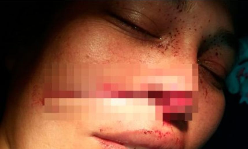 Com ciúmes, homem corta o nariz da esposa com terçado no Amazonas