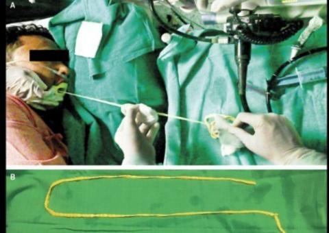 Médicos tiram verme de quase dois metros pela boca de paciente