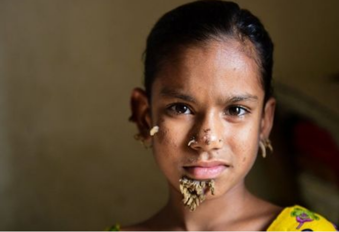 Menina pode ser a primeira pessoa do sexo feminino com ‘doença do homem-árvore’