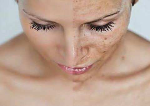 Manchas no rosto podem ser tratadas com raiz de planta medicinal