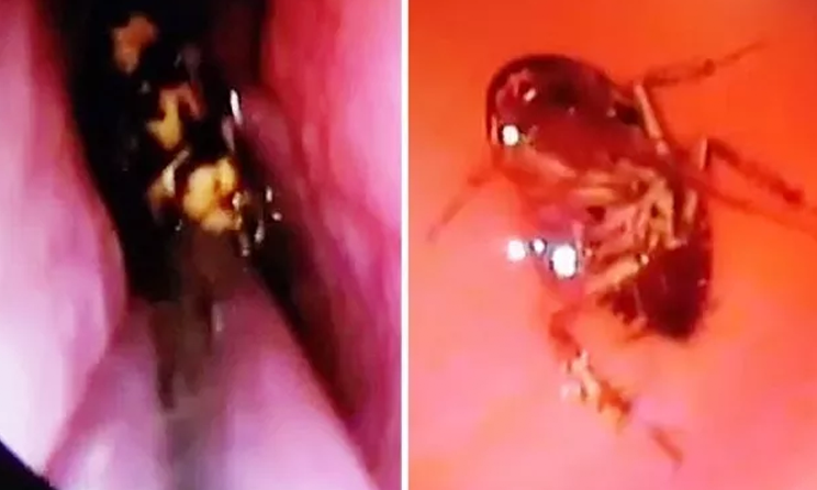 Mulher vai para no hospital com fortes dores e médicos encontram barata viva em lugar inesperado