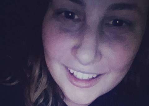 Jovem tem que amputar o pé mas ninguém pode imaginar o que ela fez com o esqueleto depois