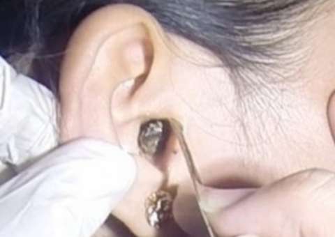 Mulher vai ao hospital com dores insuportáveis no ouvido e médico encontra algo vivo no crânio