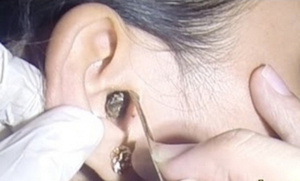 Mulher vai ao hospital com dores insuportáveis no ouvido e médico encontra algo vivo no crânio