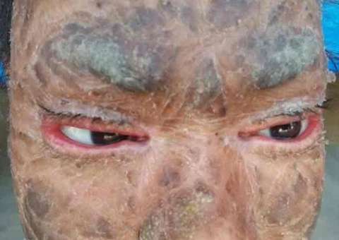 Foto de 'jovem serpente' viraliza na internet por condição rara que a faz trocar de pele