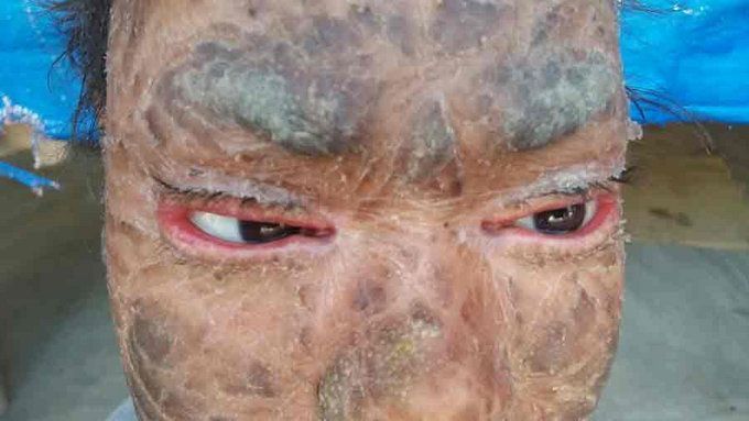 Foto de 'jovem serpente' viraliza na internet por condição rara que a faz trocar de pele