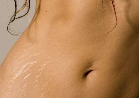 Sete coisas que talvez você não saiba sobre as estrias e vai  te surpreender 