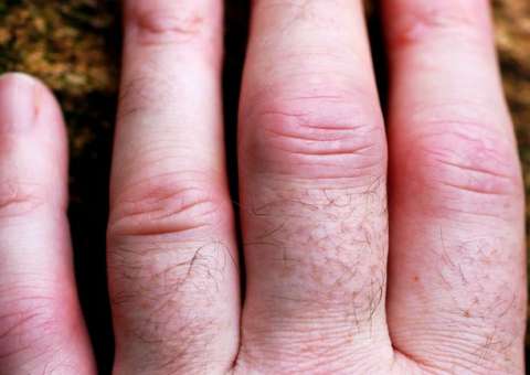 Droga para artrite reumatoide passará a ser distribuída no SUS 