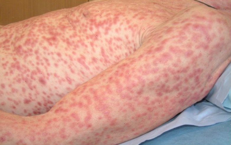 Ação busca prevenir aumento de sífilis no Amazonas