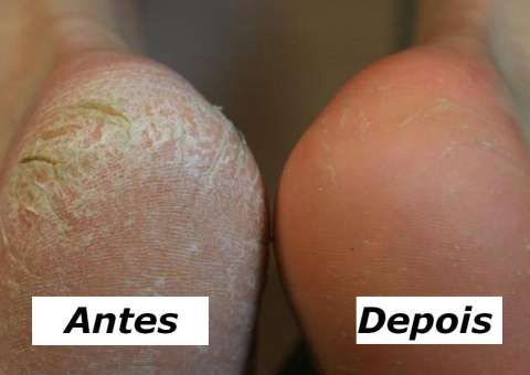 Receita caseira promete acabar com as rachaduras nos pés