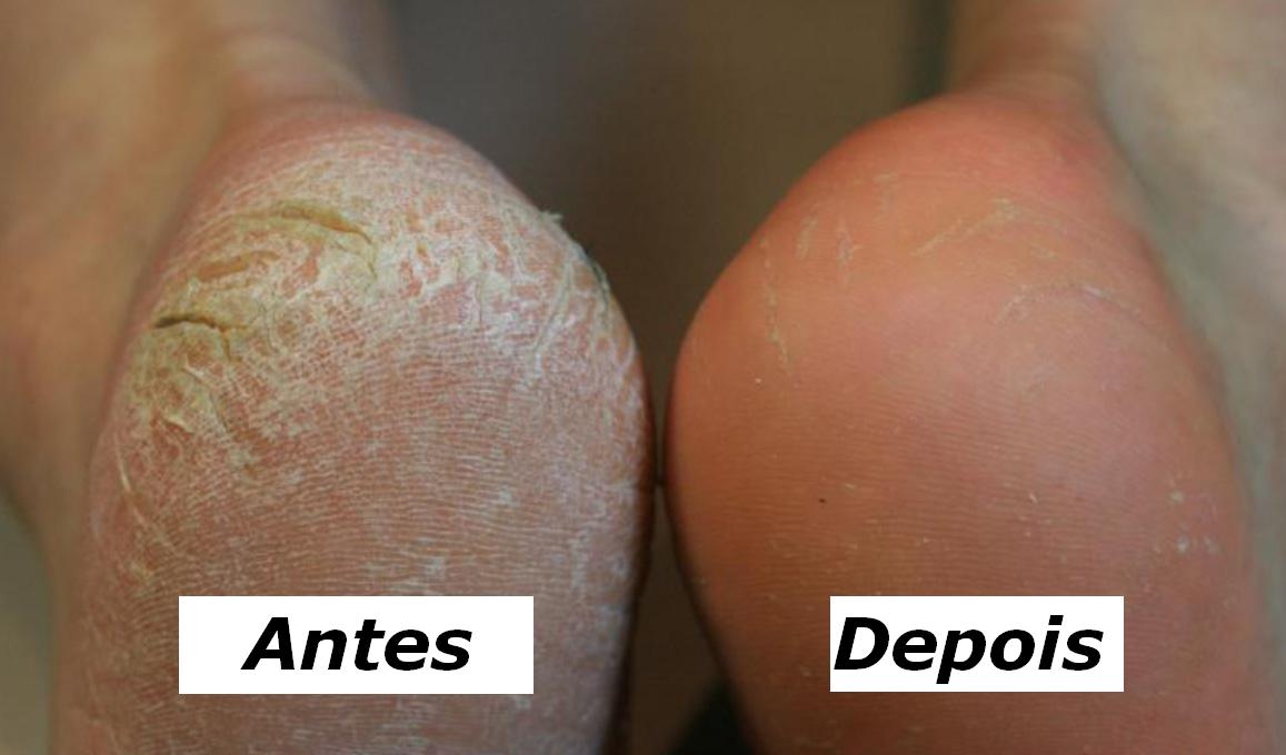 Receita caseira promete acabar com as rachaduras nos pés