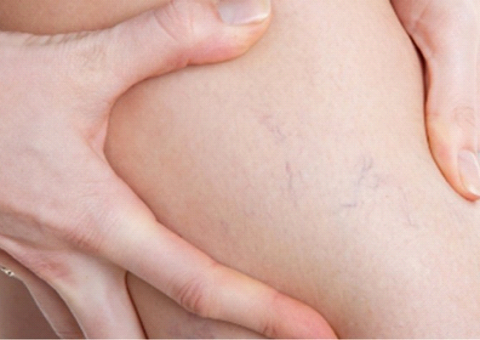 Receita caseira pode eliminar microvarizes