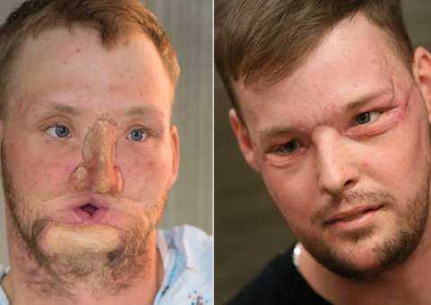 Transplante de rosto dá nova chance a americano que atirou em si mesmo