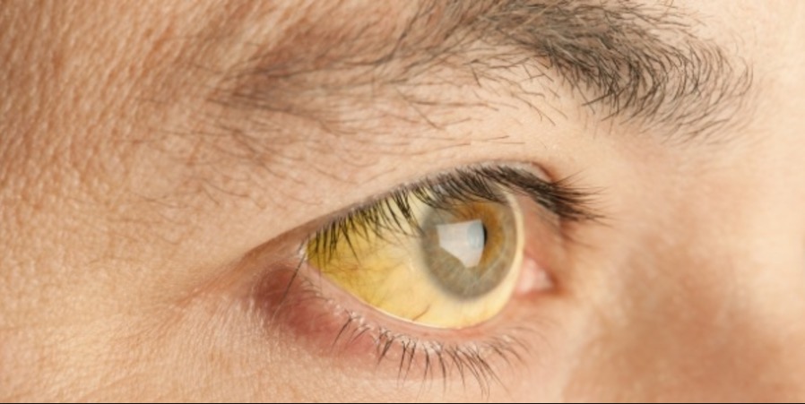 Sobe para 89 número de mortes confirmadas por febre amarela