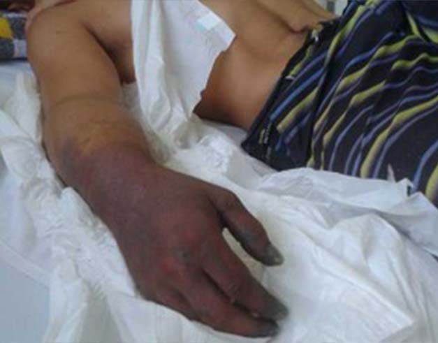  Jovem perde o braço após aplicação errada de injeção em hospital 