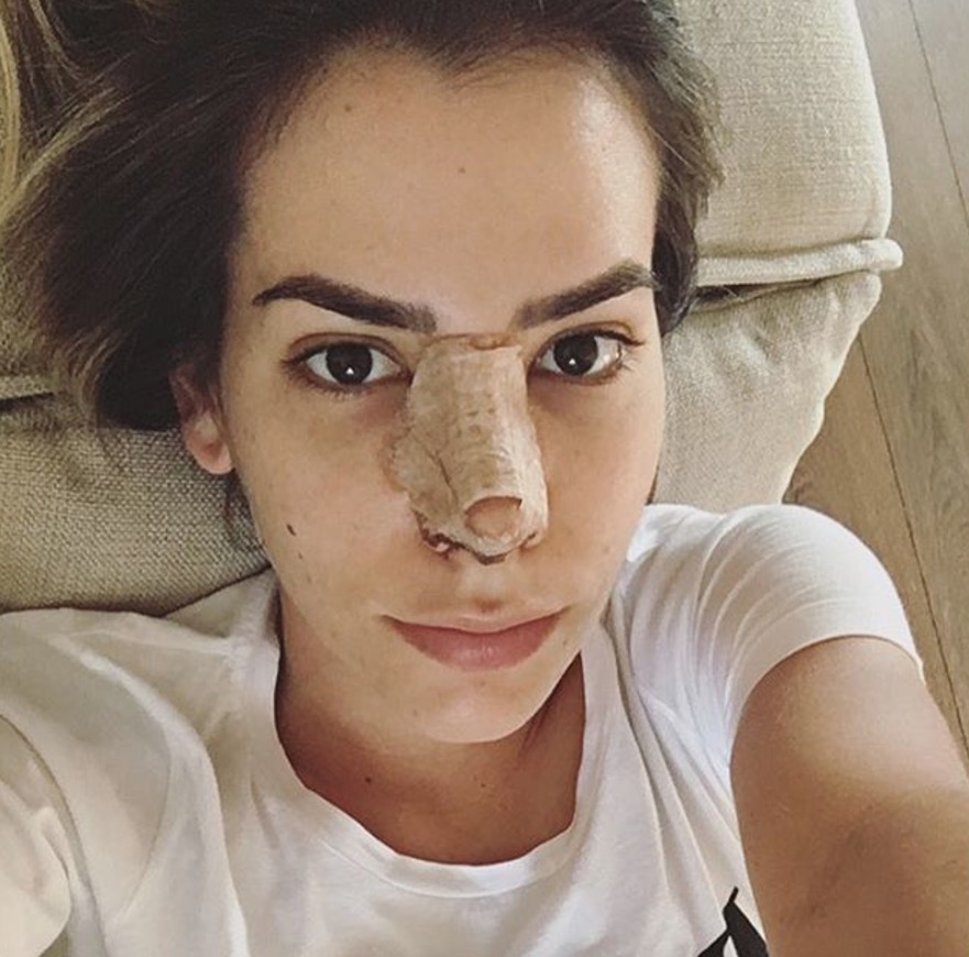  Adriana Sant'Anna faz segunda plástica no nariz e mostra foto pós-cirurgia