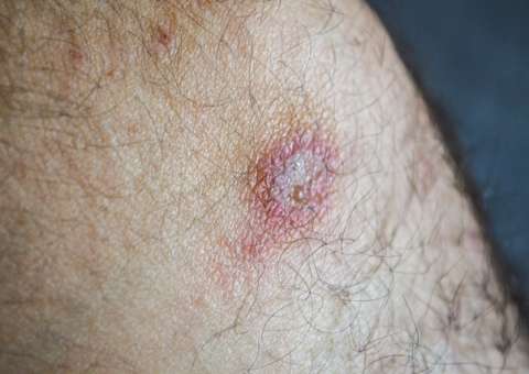 Carnaval na zona rural faz alerta para leshmaniose