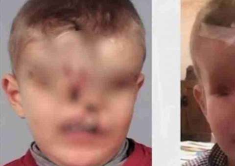 Criança tem rosto reconstruído após nascer sem olhos e sem nariz 