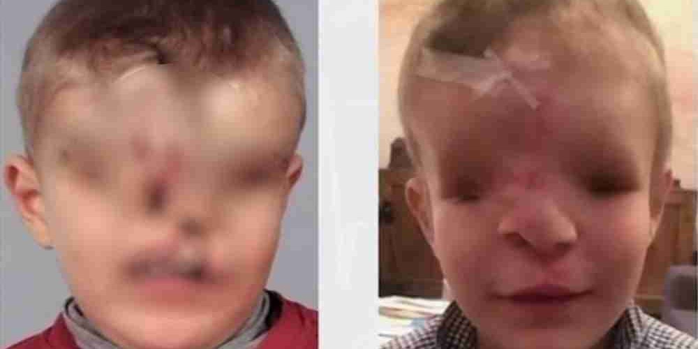 Criança tem rosto reconstruído após nascer sem olhos e sem nariz 