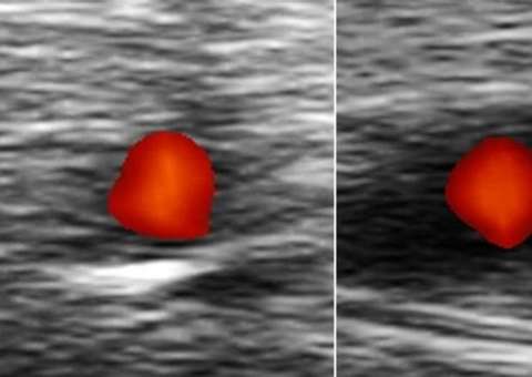 Como identificar sintomas da doença que causa cegueira repentina