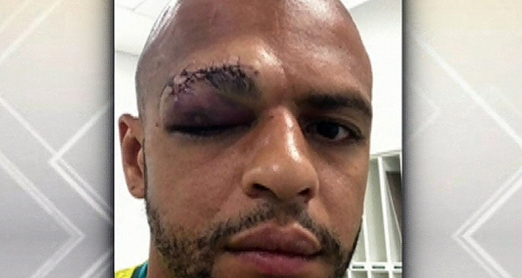 Felipe Melo leva 20 pontos no supercílio e está fora da próxima partida