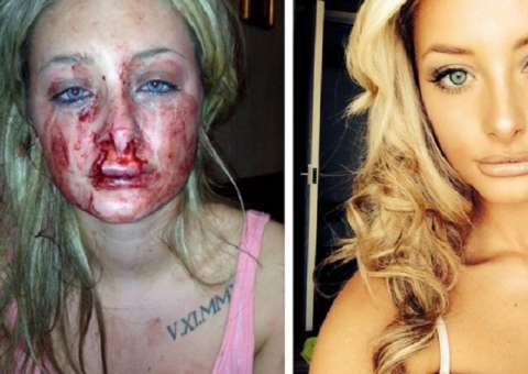 Mulher fica com rosto desfigurado ao tentar terminar namoro