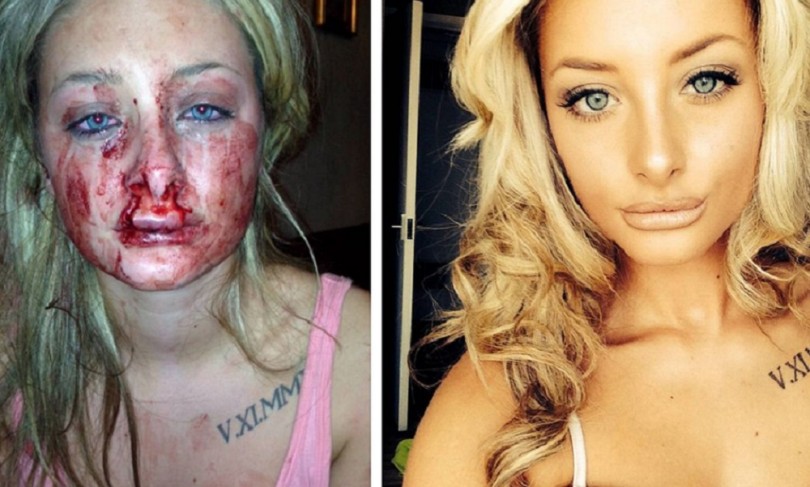 Mulher fica com rosto desfigurado ao tentar terminar namoro