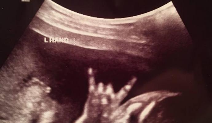 Feto faz suposto sinal de 'mão-chifrada' em ultrassom e pais se surpreendem