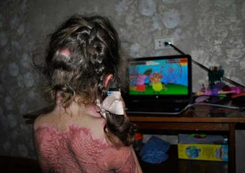 Crianças sofrem queimaduras após serem vítimas de jogo online que promete torná-las “fadas de fogo”