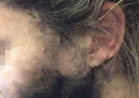 Mulher tem rosto queimado por fone de ouvido durante voo