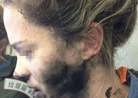 Mulher sofre queimaduras após explosão de fones de ouvido durante voo