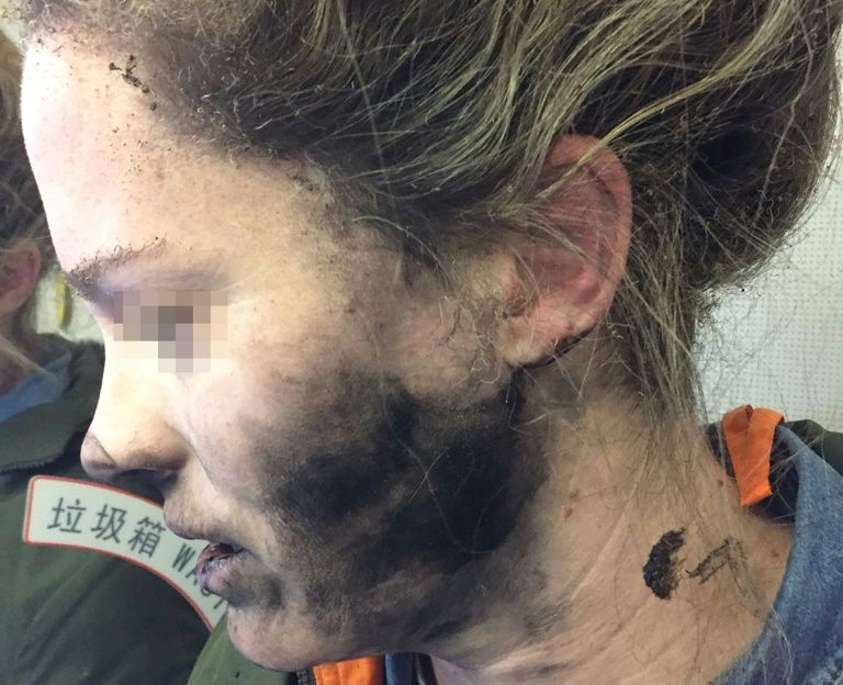 Mulher sofre queimaduras após explosão de fones de ouvido durante voo