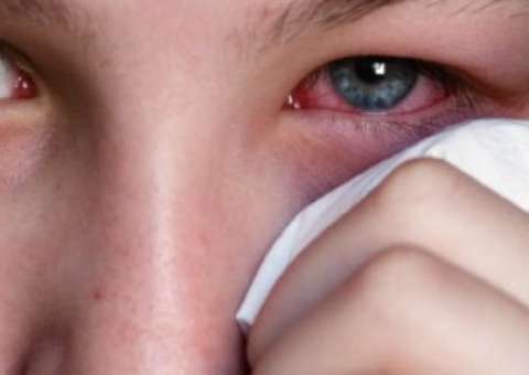 Planta medicinal auxilia no tratamento de conjuntivite