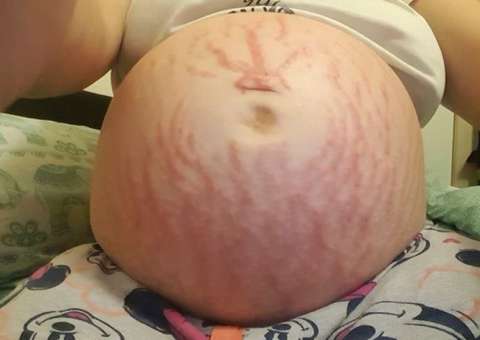 Grávida descobre que é alérgica à própria filha 