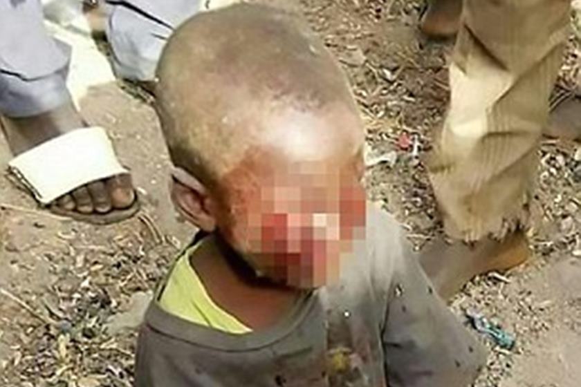 Criança de 4 anos tem olhos arrancados pela madrasta 