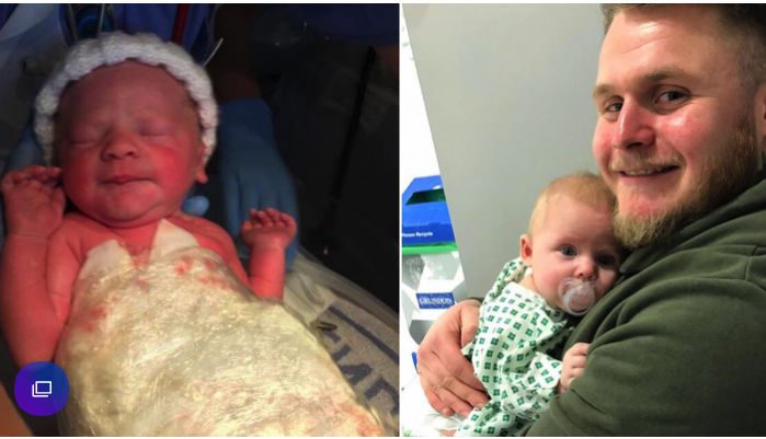 Bebê nasce com intestinos do lado de fora do corpo e é salva por plástico filme