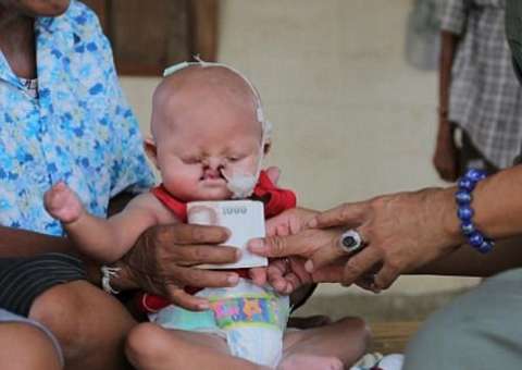 Bebê 'sereia': Imagem impressionante mostra criança que sofre com doença rara