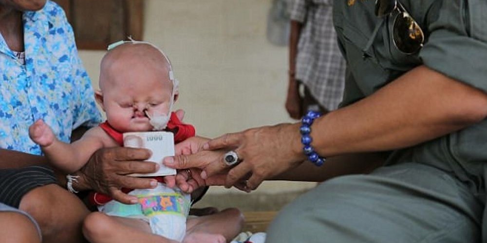 Bebê 'sereia': Imagem impressionante mostra criança que sofre com doença rara