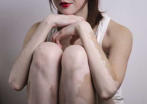 Pesquisa mostra atuação de planta no combate ao vitiligo 