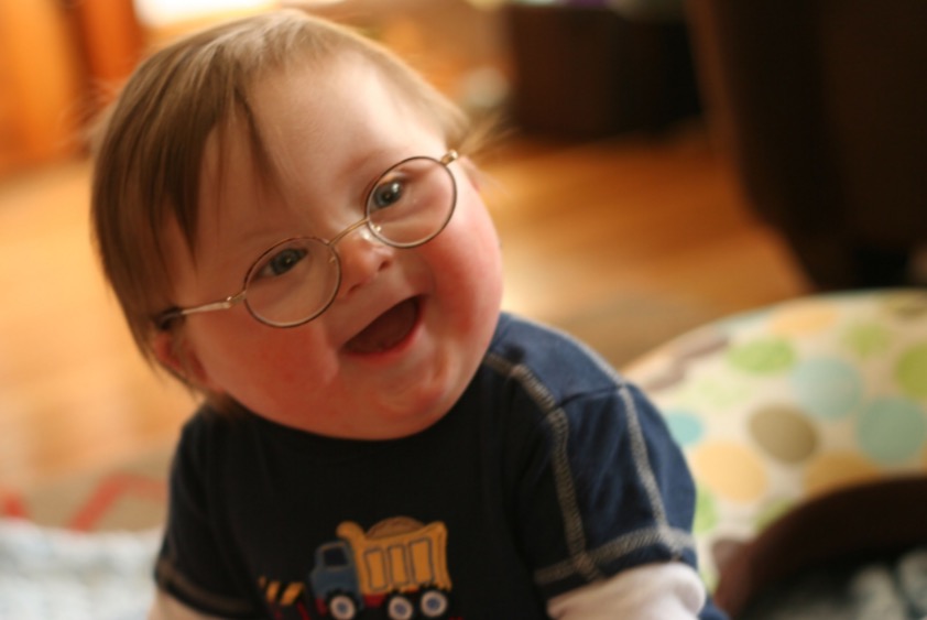 Síndrome de Down: carinho é o melhor remédio