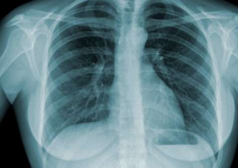 Campanha contra tuberculose inicia nesta sexta-feira em Manaus 