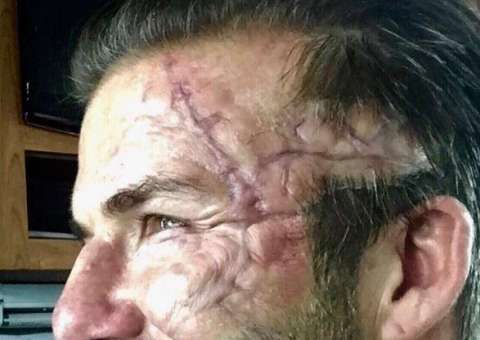 David Beckham assusta fãs ao aparecer com rosto desfigurado nas redes sociais