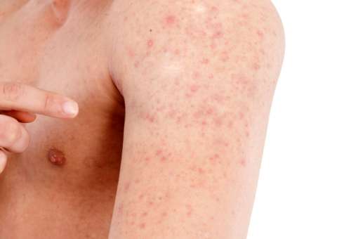 Planta pode ser usada para tratar doenças cutâneas e irritações 