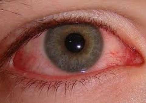  O que fazer quando os olhos não pararem de lacrimejar ?