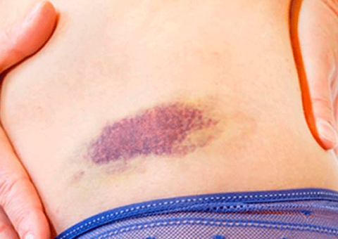 Planta trata manchas roxas após pancadas na pele 