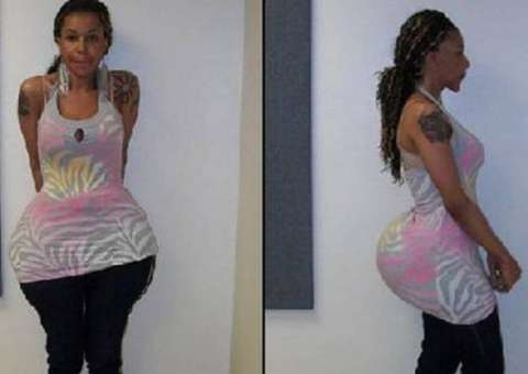 Falsa médica é condenada por injetar cimento em cirurgias plásticas 